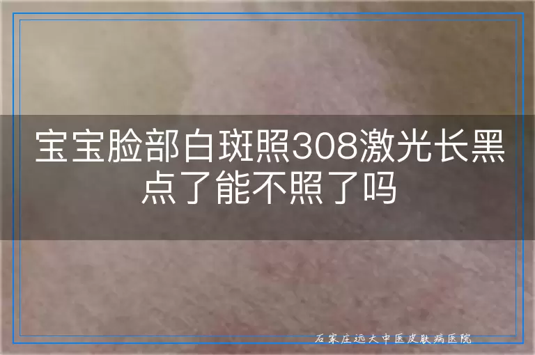 宝宝脸部白斑照308激光长黑点了能不照了吗