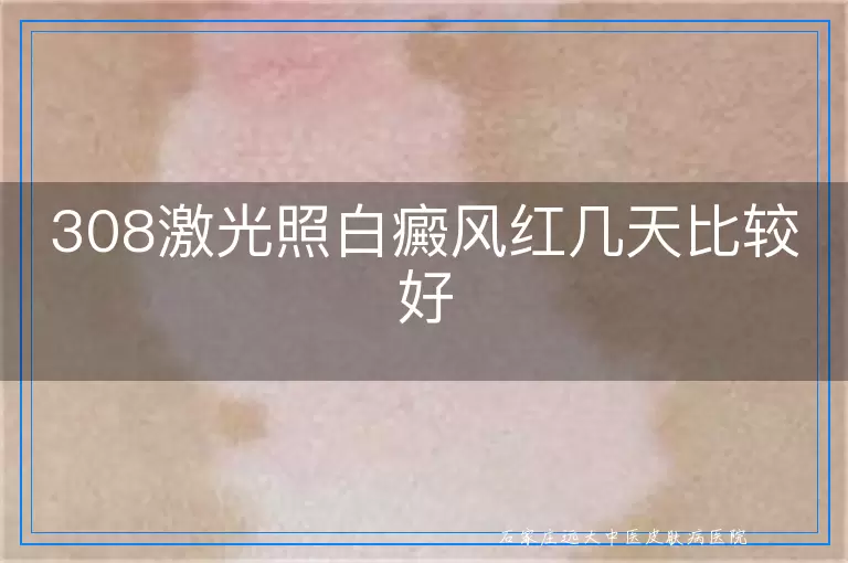308激光照白癜风红几天比较好