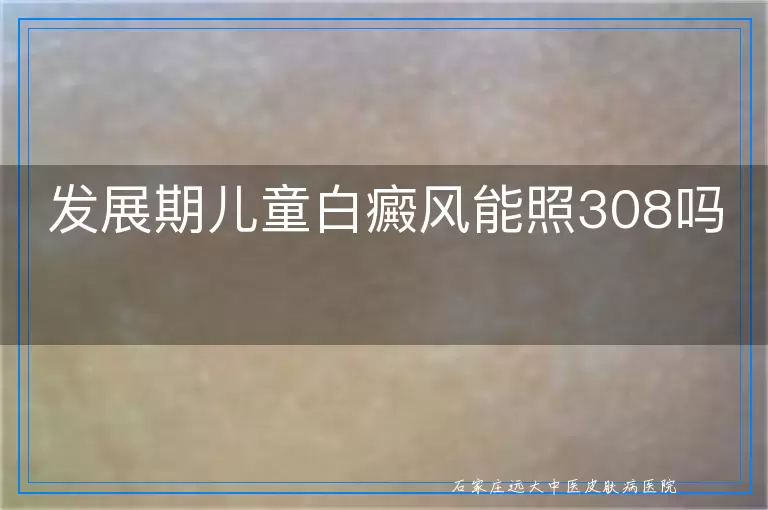 发展期儿童白癜风能照308吗