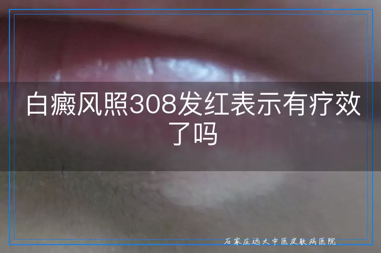 白癜风照308发红表示有疗效了吗