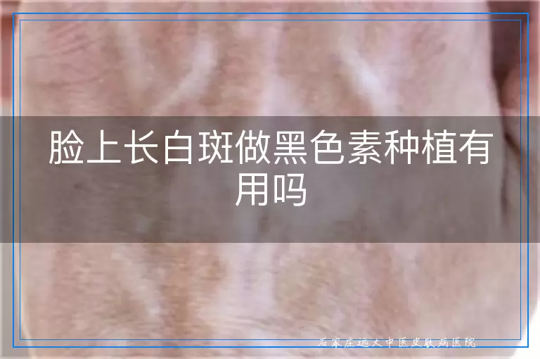 脸上长白斑做黑色素种植有用吗