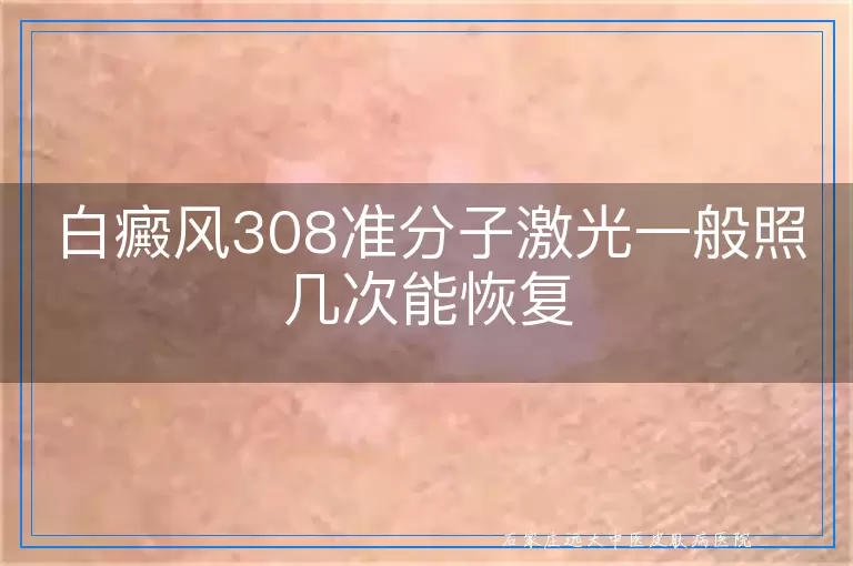 白癜风308准分子激光一般照几次能恢复