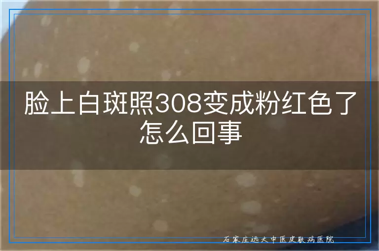 脸上白斑照308变成粉红色了怎么回事