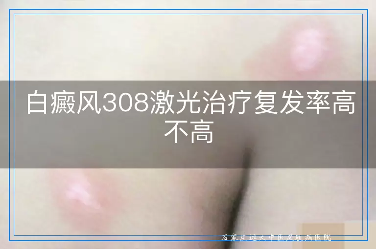 白癜风308激光治疗复发率高不高