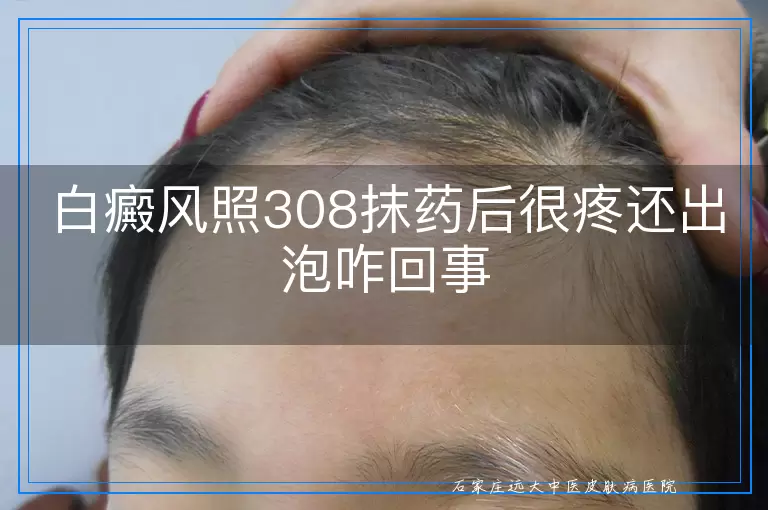 白癜风照308抹药后很疼还出泡咋回事