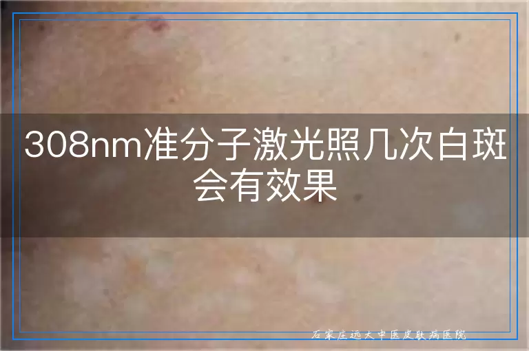 308nm准分子激光照几次白斑会有效果