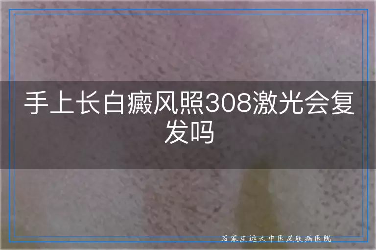 手上长白癜风照308激光会复发吗