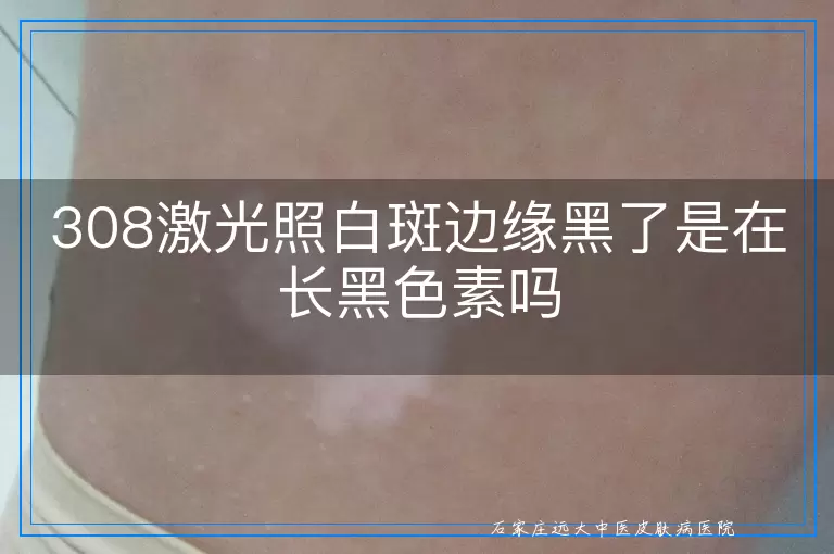308激光照白斑边缘黑了是在长黑色素吗