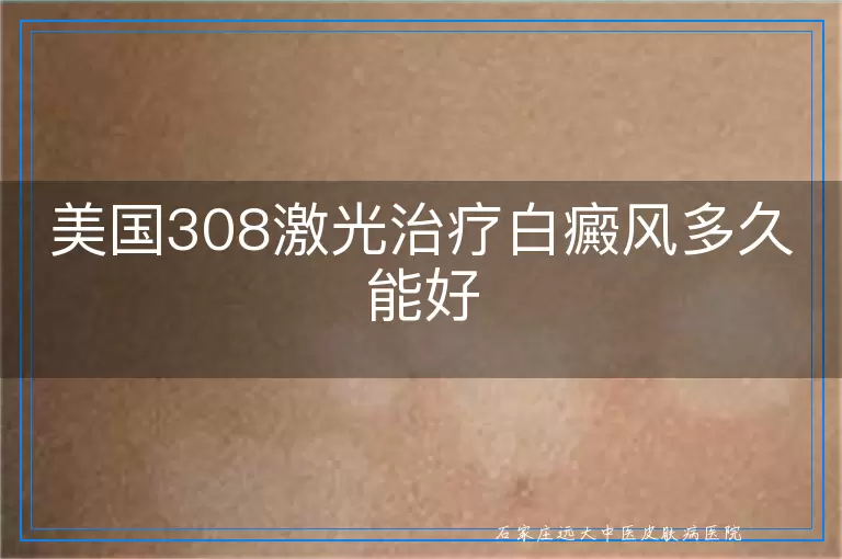 美国308激光治疗白癜风多久能好