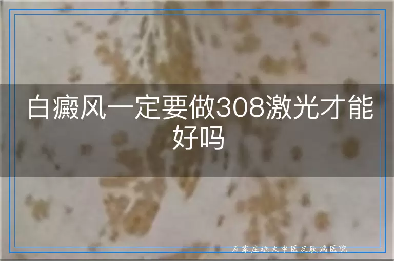 白癜风一定要做308激光才能好吗
