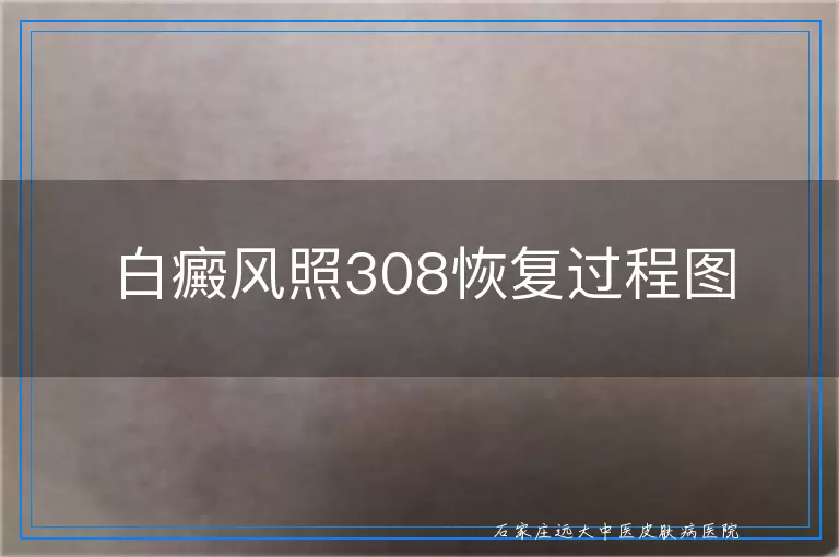 白癜风照308恢复过程图