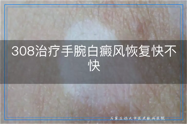 308治疗手腕白癜风恢复快不快