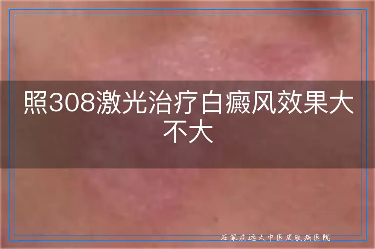 照308激光治疗白癜风效果大不大