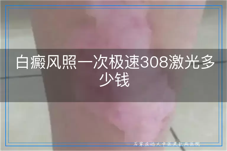 白癜风照一次极速308激光多少钱