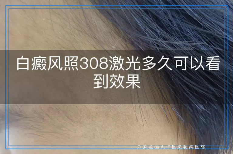 白癜风照308激光多久可以看到效果