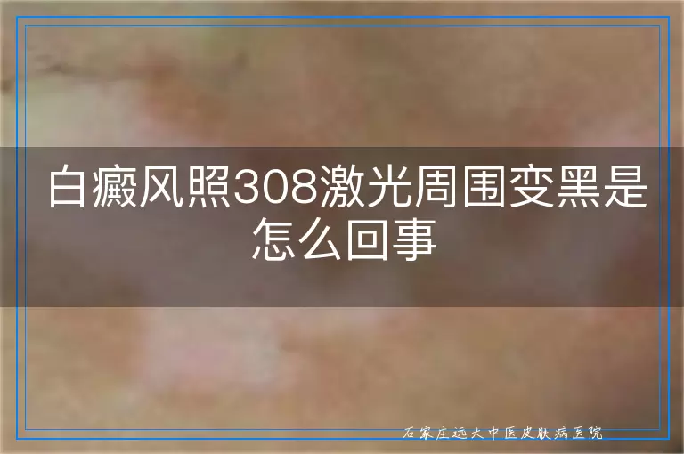 白癜风照308激光周围变黑是怎么回事