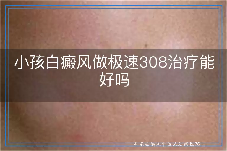 小孩白癜风做极速308治疗能好吗