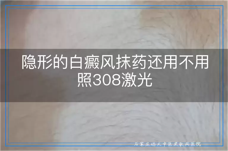 隐形的白癜风抹药还用不用照308激光