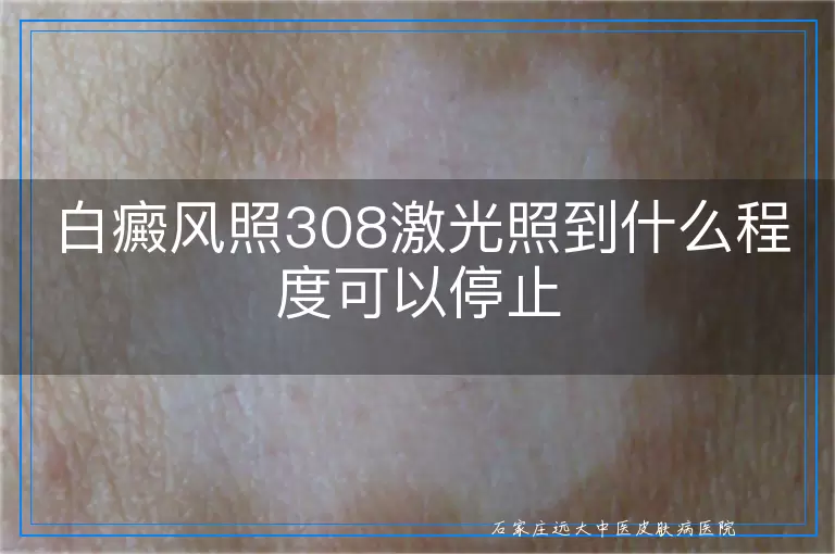白癜风照308激光照到什么程度可以停止