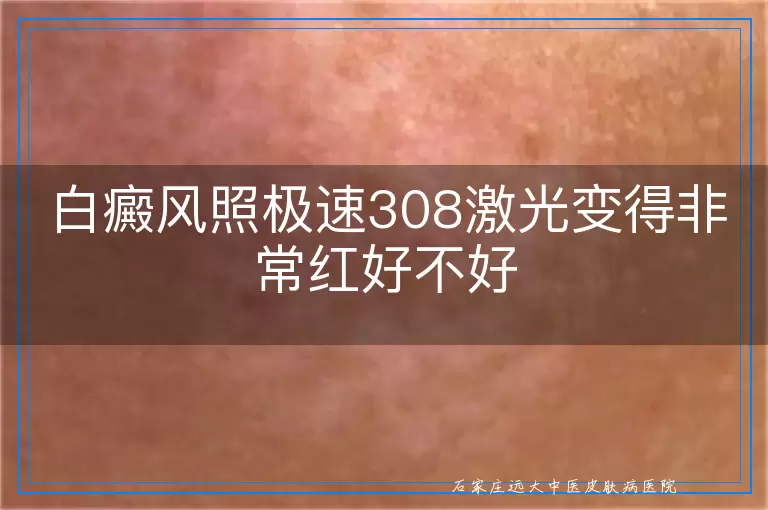 白癜风照极速308激光变得非常红好不好