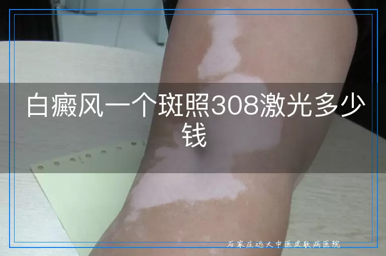 白癜风一个斑照308激光多少钱