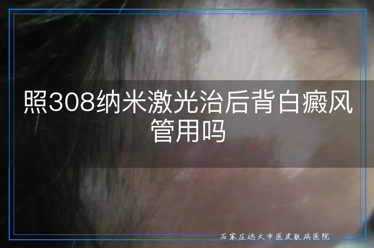 照308纳米激光治后背白癜风管用吗
