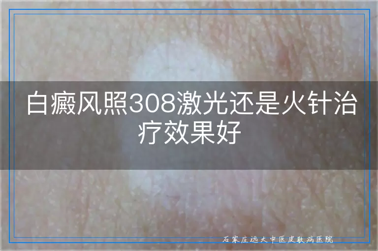 白癜风照308激光还是火针治疗效果好