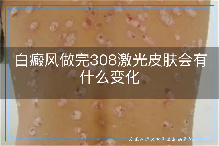 白癜风做完308激光皮肤会有什么变化