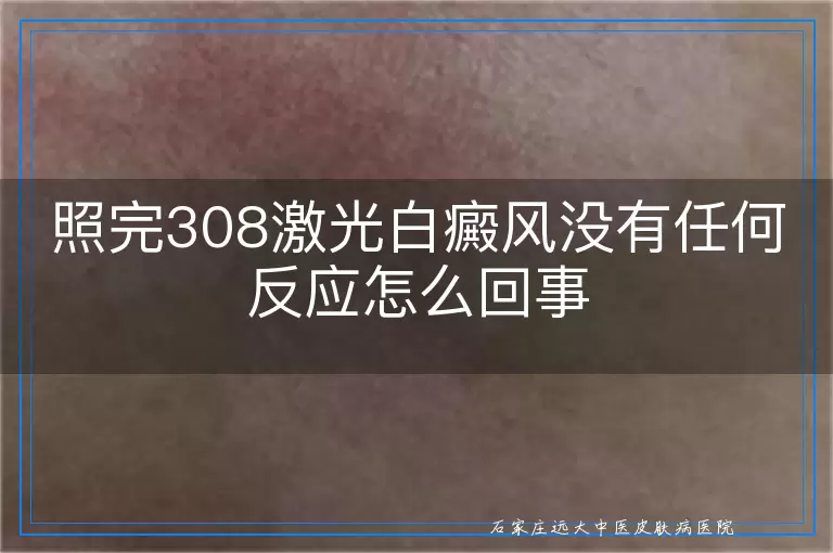 照完308激光白癜风没有任何反应怎么回事