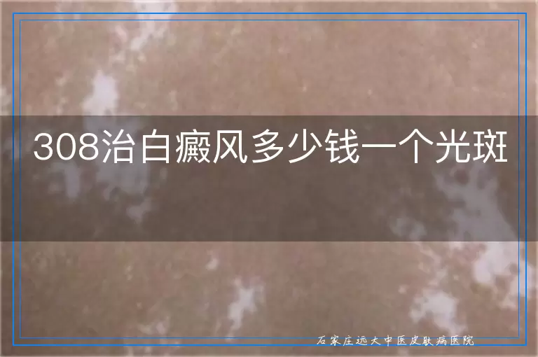 308治白癜风多少钱一个光斑