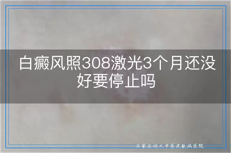 白癜风照308激光3个月还没好要停止吗