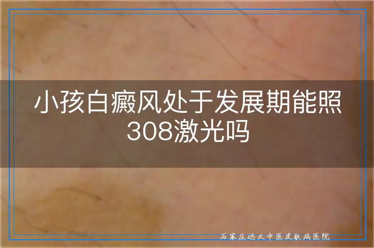 小孩白癜风处于发展期能照308激光吗