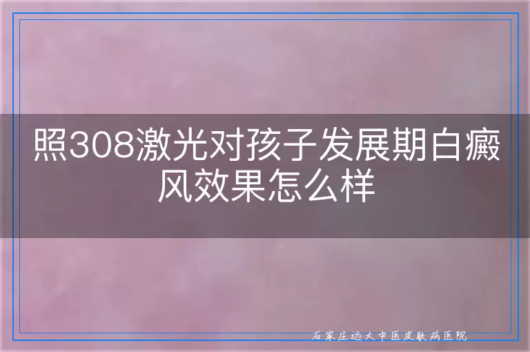 照308激光对孩子发展期白癜风效果怎么样