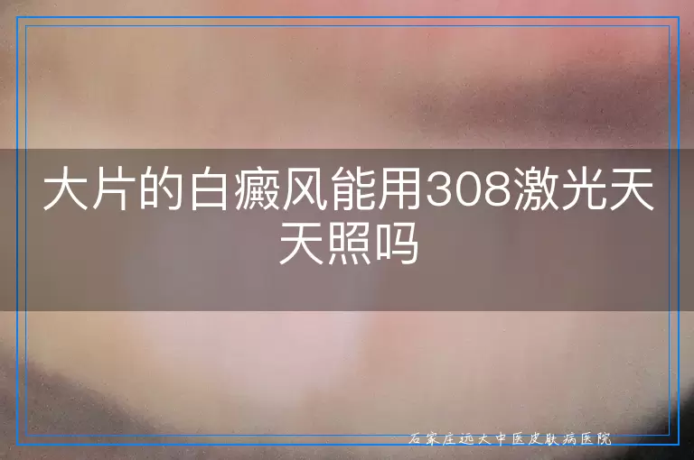 大片的白癜风能用308激光天天照吗