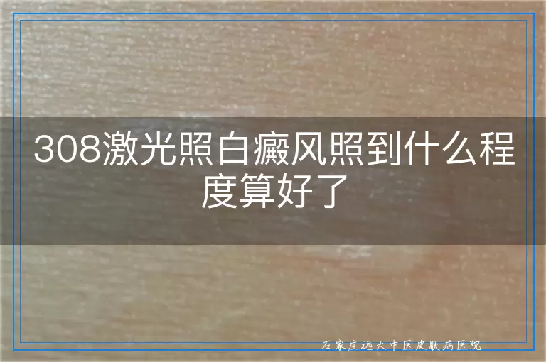 308激光照白癜风照到什么程度算好了