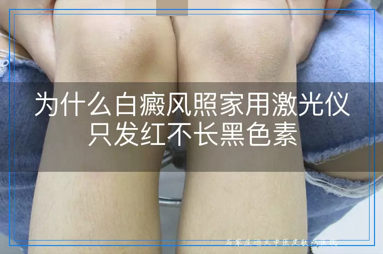 为什么白癜风照家用激光仪只发红不长黑色素