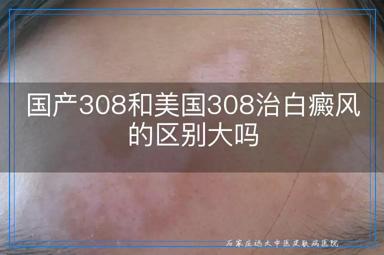 国产308和美国308治白癜风的区别大吗