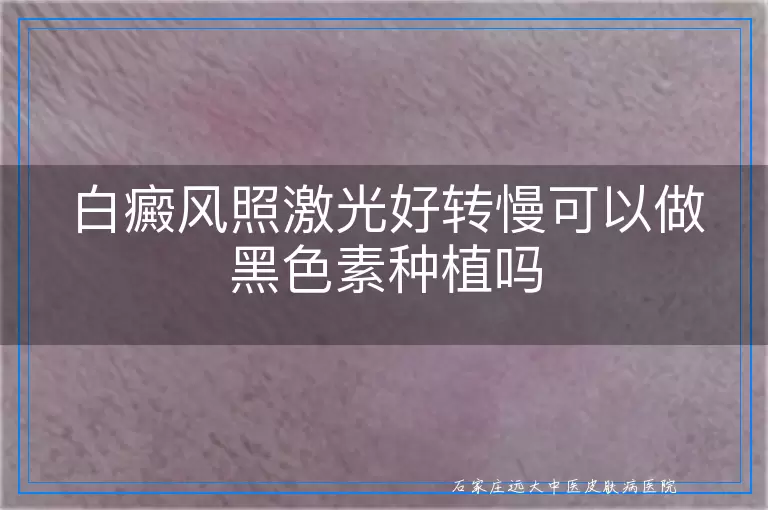 白癜风照激光好转慢可以做黑色素种植吗