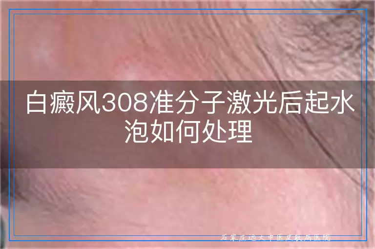 白癜风308准分子激光后起水泡如何处理