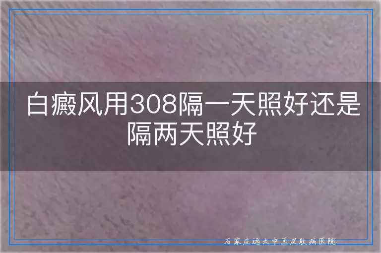 白癜风用308隔一天照好还是隔两天照好
