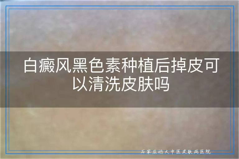 白癜风黑色素种植后掉皮可以清洗皮肤吗