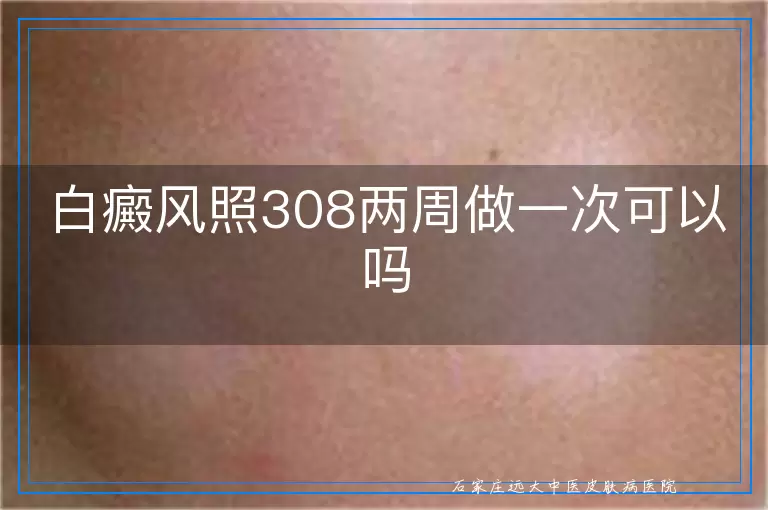 白癜风照308两周做一次可以吗