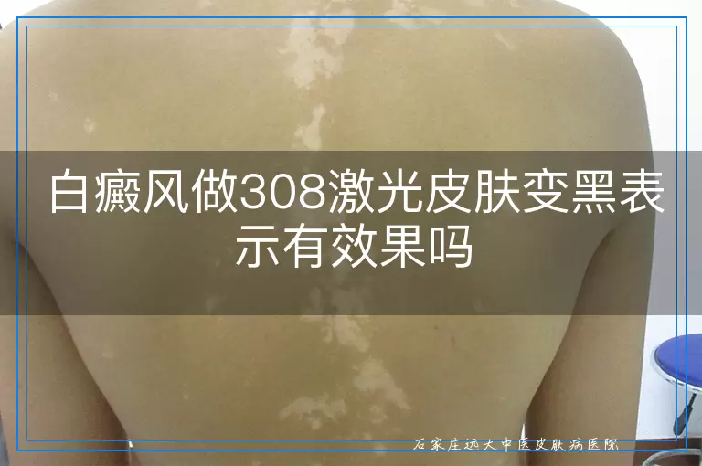 白癜风做308激光皮肤变黑表示有效果吗