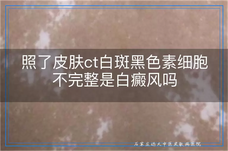 照了皮肤ct白斑黑色素细胞不完整是白癜风吗
