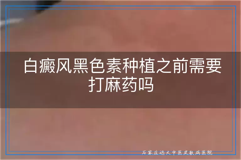 白癜风黑色素种植之前需要打麻药吗