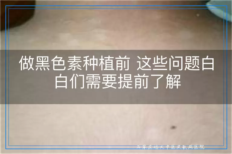 做黑色素种植前 这些问题白白们需要提前了解