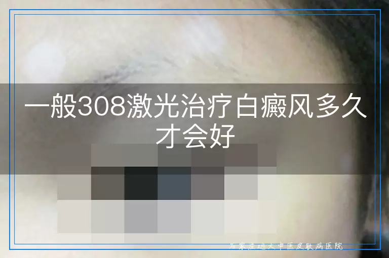 一般308激光治疗白癜风多久才会好