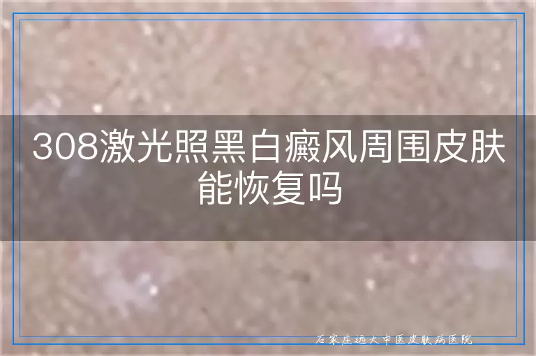 308激光照黑白癜风周围皮肤能恢复吗