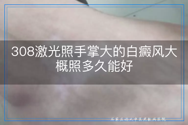 308激光照手掌大的白癜风大概照多久能好