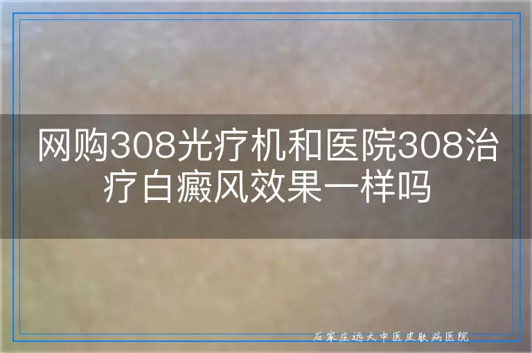网购308光疗机和医院308治疗白癜风效果一样吗